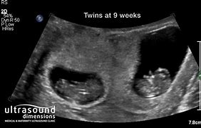Image result for 5 Week Loss at 9 Weeks Tissue