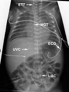 Image result for Umbilical Cord Artery and Vein