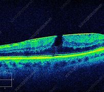 Image result for Macular Hole OCT Scan