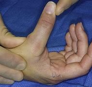 Image result for Thumb Meme Ligament