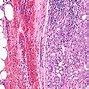 Image result for Tumor On Pancreas