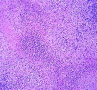 Image result for Granuloma Venereum