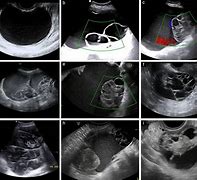 Image result for Mucinous Ovarian Cyst Ultrasound