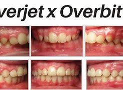 Image result for How to Measure Overjet and Overbite