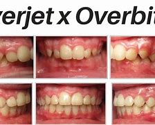 Image result for Overjet vs Overbite