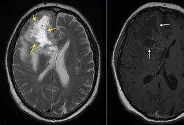 Image result for Glioblastoma Multiforme MRI