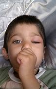 Image result for Allergic Reaction to Apple's