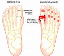 Image result for Foot Pain Big Toe