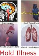 Image result for Mold Allergies Symptoms