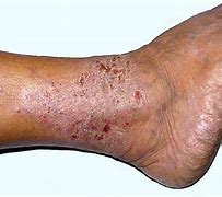 Image result for DVT Itchy Ankles
