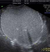 Image result for Dermoid Cyst Ultrasound Appearance