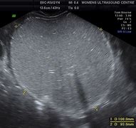 Image result for Dermoid Cyst Ultrasound