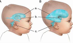 Image result for External Hydrocephalus