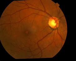 Image result for Solar Maculopathy Oct