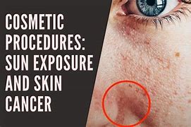 Image result for Skin Cancer From Sun Exposure