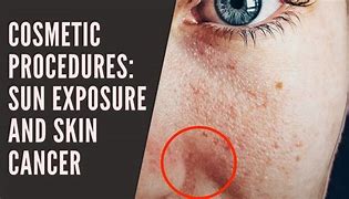 Image result for Skin Cancer From the Sun