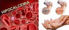 Image result for hipocalcemia