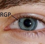 Image result for Rigid Contact Lenses