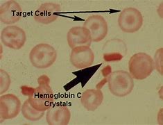 Image result for Hemoglobin C Trait