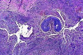 Image result for actinomocosis