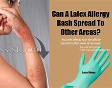 Image result for Allergy Latex Allergic Reaction