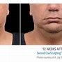 Image result for CoolSculpting Face