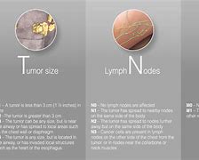 Image result for Lung Cancer Tumor Size Chart