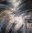 Image result for Red Scabs On Scalp