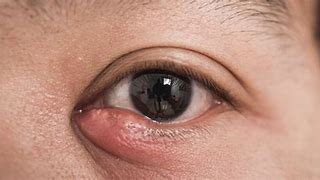 Image result for Swollen Lower Eyelid