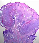 Image result for Kaposi Sarcoma Histology
