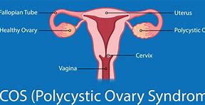 Image result for 2.7 Cm Cyst On Ovary