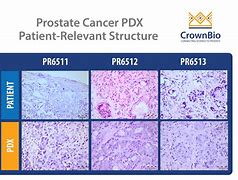 Image result for Size of Prostate Tumor