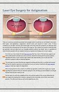 Image result for Astigmatism Eye Surgery