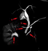 Image result for MRI MRCP Pancreas