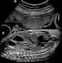 Image result for Gastroschisis Fetal Ultrasound