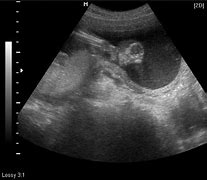 Image result for Severe Anencephaly