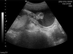 Image result for Anencephaly Bad Case