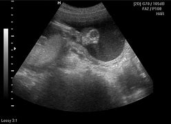 Image result for Anencephaly Treatments