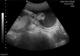 Image result for Fetal Anencephaly