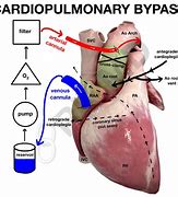 Image result for Adams Right Bypass