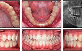 Image result for Maxillary Deficiency