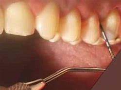 Image result for Dental Scaler Sharpening Guide