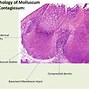 Image result for Molluscum Life Cycle
