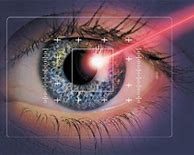 Image result for Laser Vision Correction
