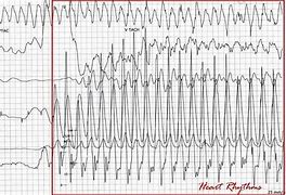 Image result for What Does CPR Look Like On EKG