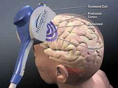 Image result for Magnetic Therapy