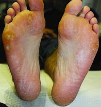 Image result for Moccasin Athlete's Foot