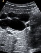 Image result for Hepatic Biliary Cystadenoma Ultrasound