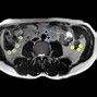 Image result for MRI T2 Axial Abdomen
