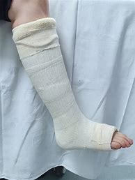 Image result for Broken Knee Cast
